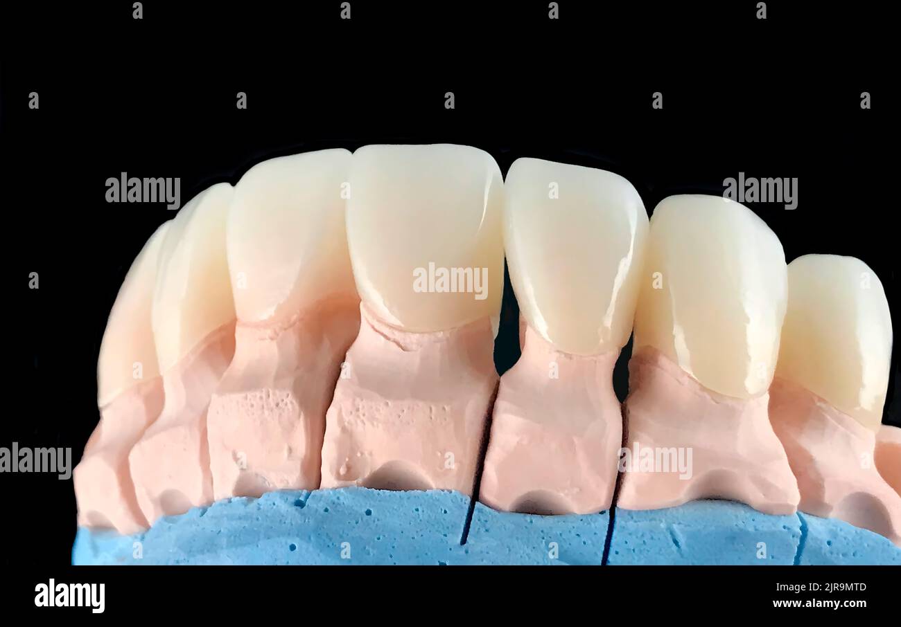 Natural look press ceramic veneers and crowns on dental plaster model