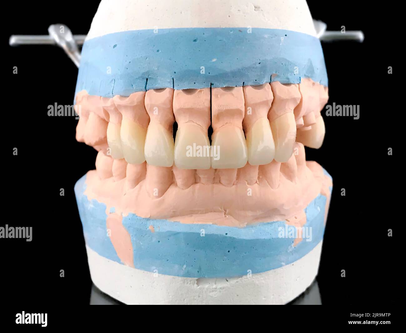 Dental porcelain prosthesis implant tooth in dental laboratory. Plaster model with all-ceramic bridge restoration. Lithium disilicate. Front view Stock Photo