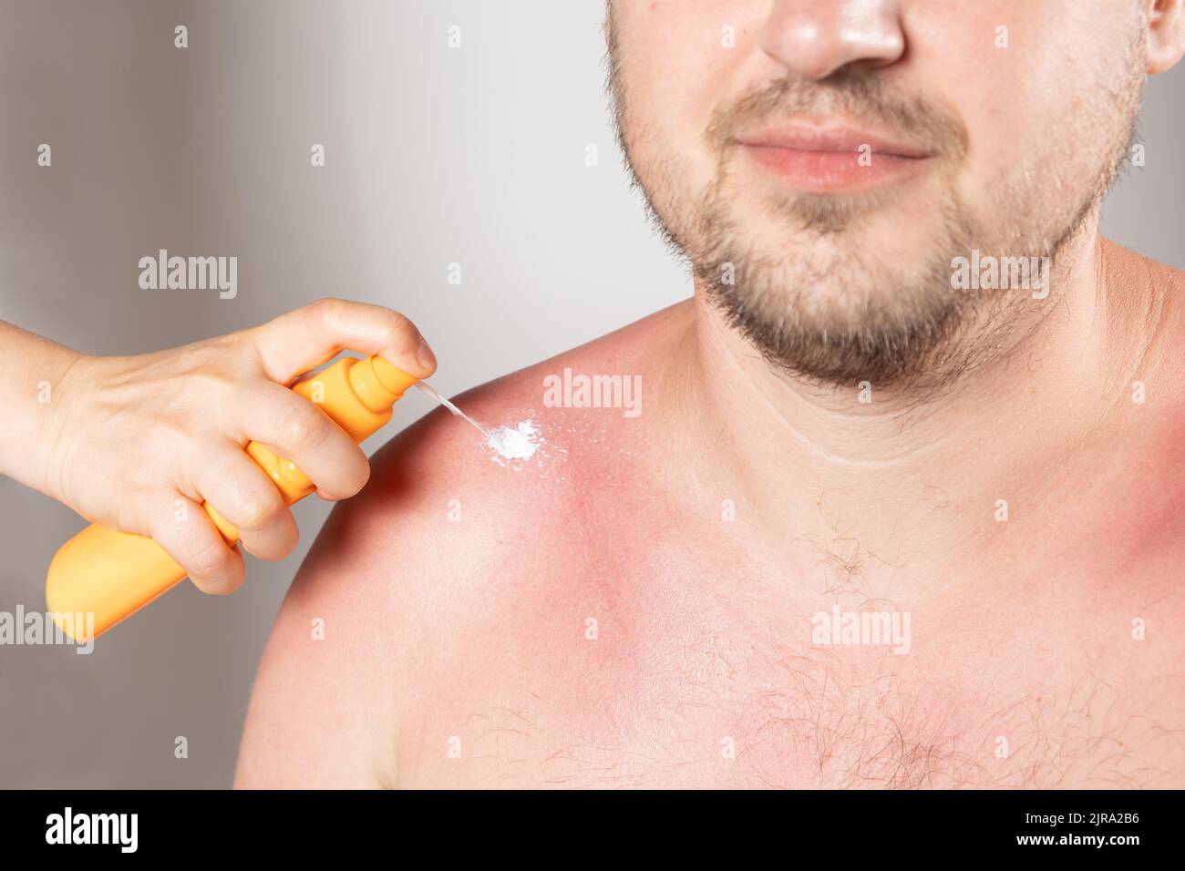 Applying sunscreen or therapeutic spray to the skin of a man with a