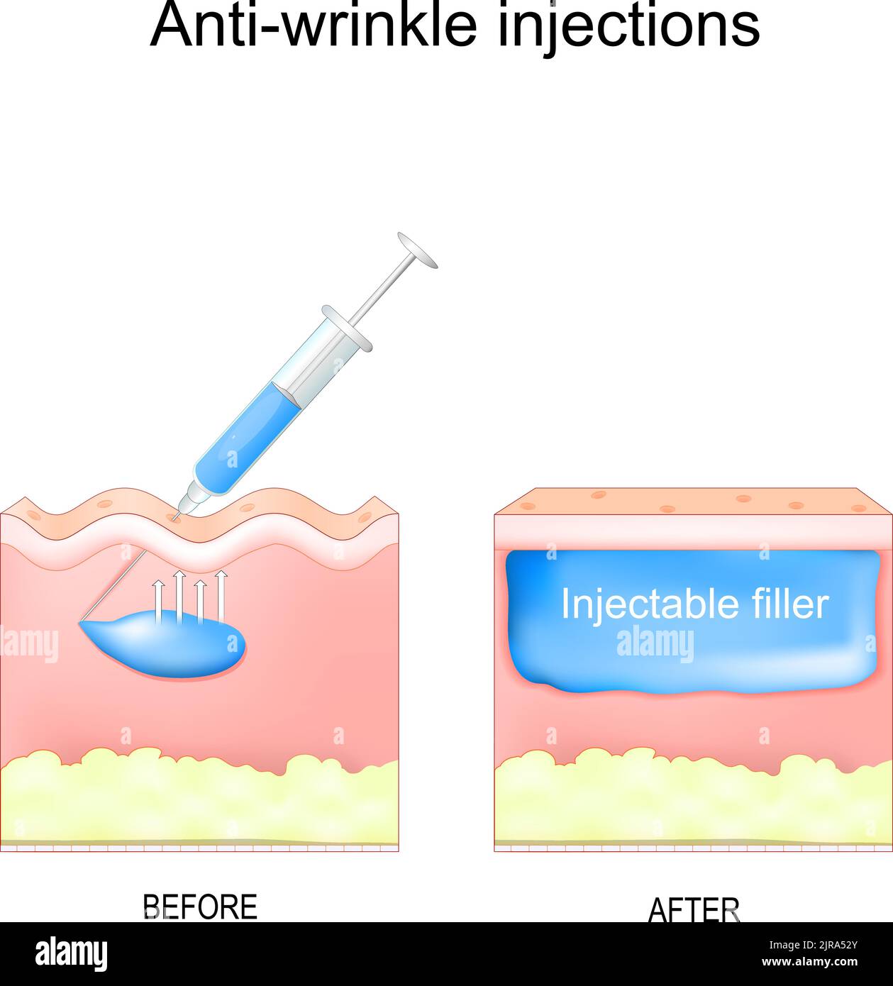 Anti-wrinkle injections. aesthetic procedure. rejuvenate the skin without surgery. Human skin with facial wrinkles before and after filler injected. s Stock Vector