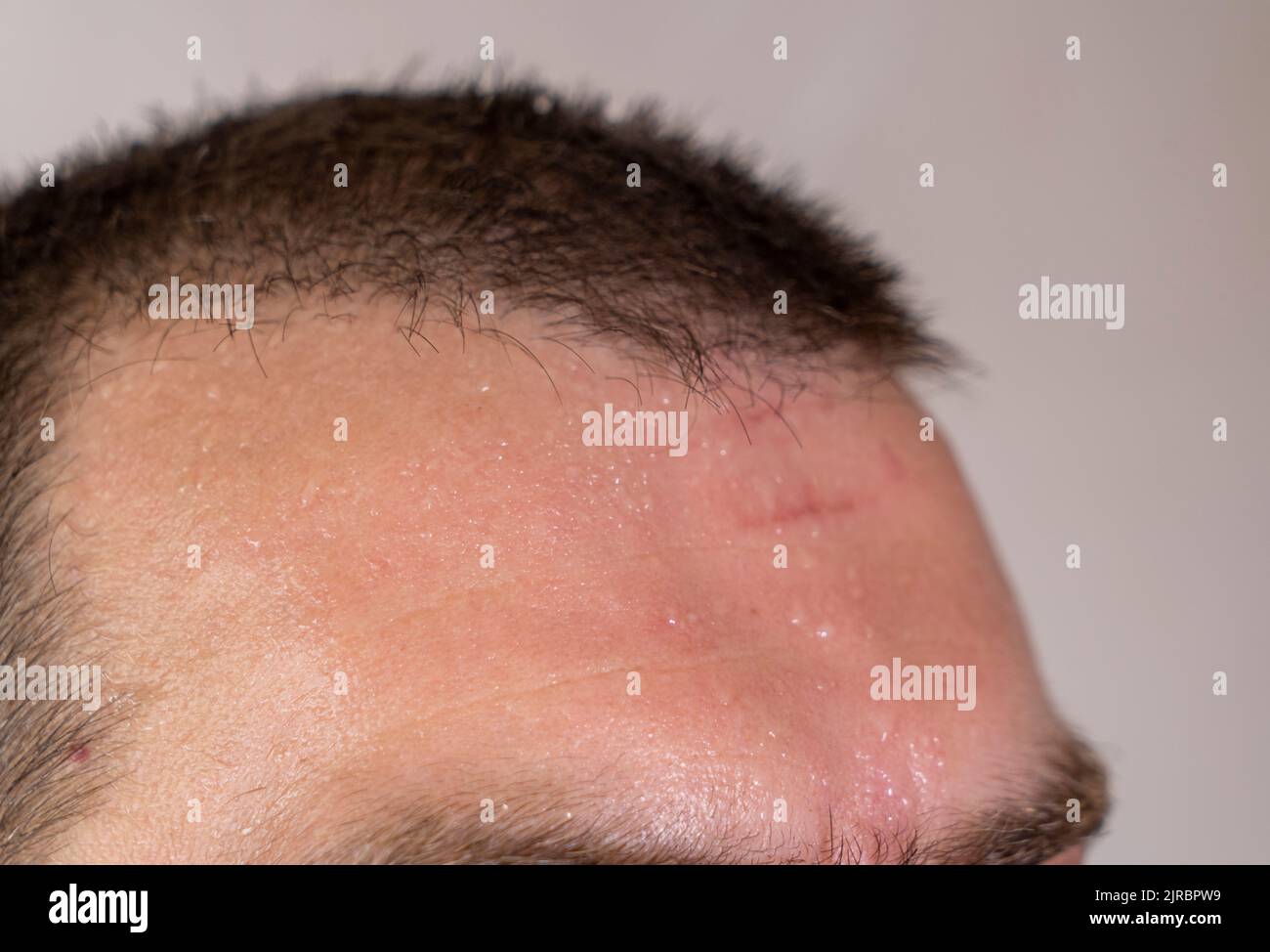 Selective focus close up shot of a short brown haired caucasian man sweaty forehead with a little scar. Stock Photo