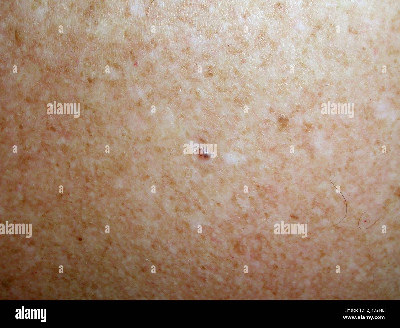 Basal cell carcinoma Stock Photo - Alamy