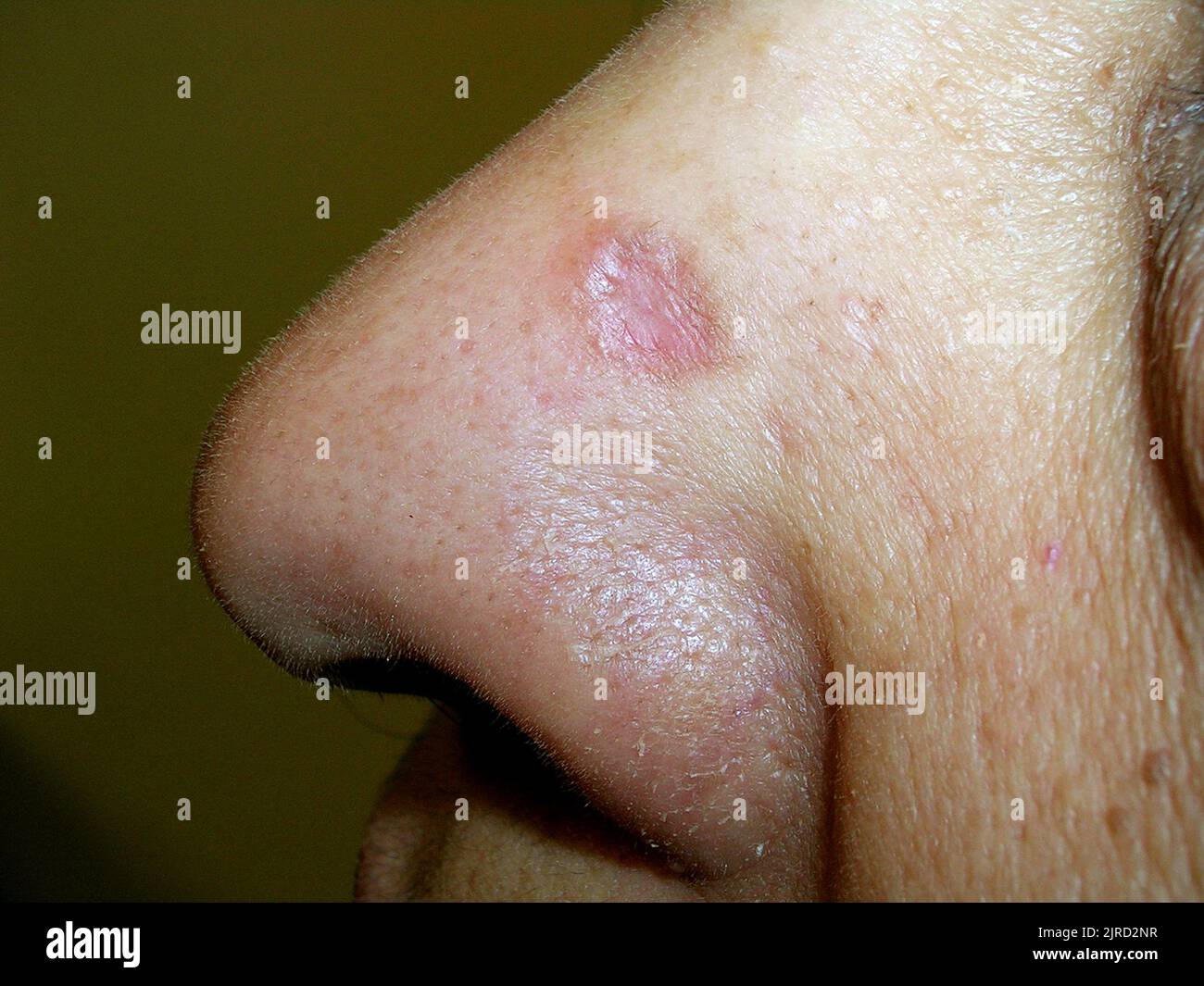 Basal cell carcinoma Stock Photo - Alamy