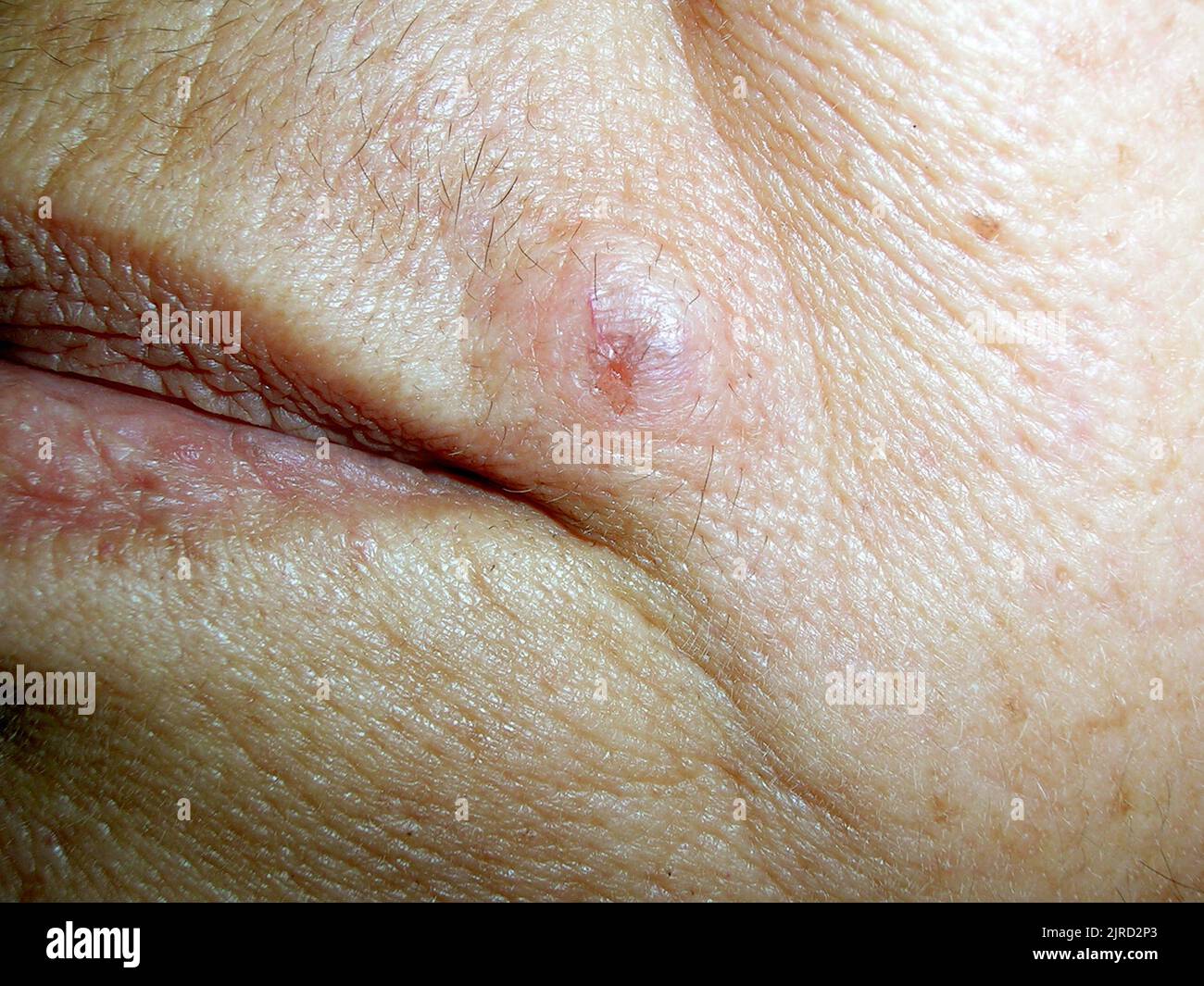 Basal cell carcinoma Stock Photo - Alamy