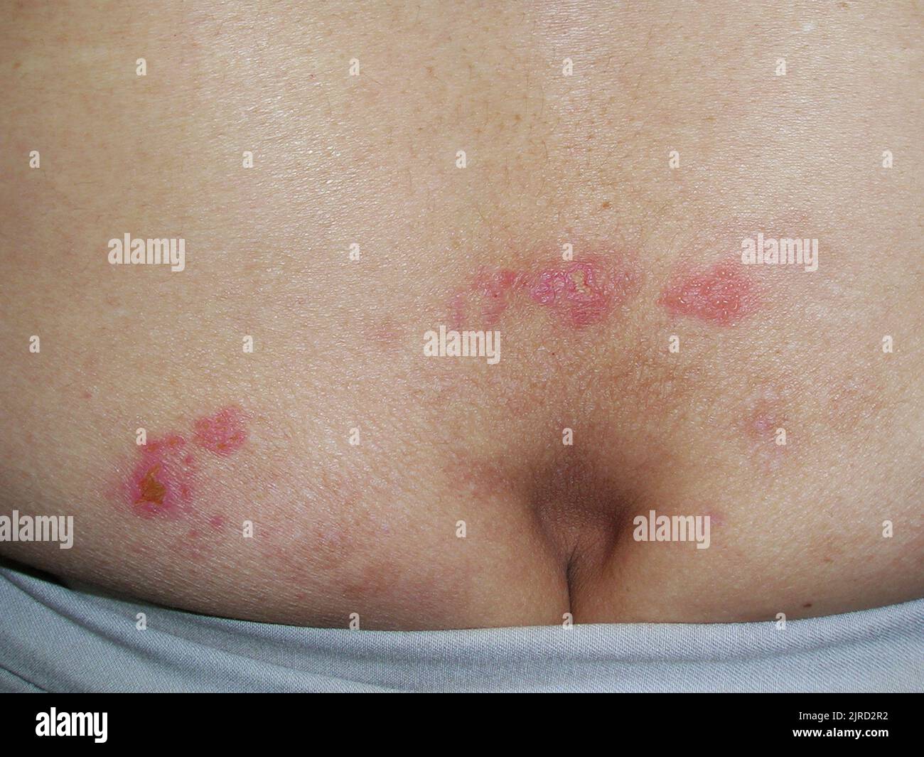 Genital herpes infection Stock Photo