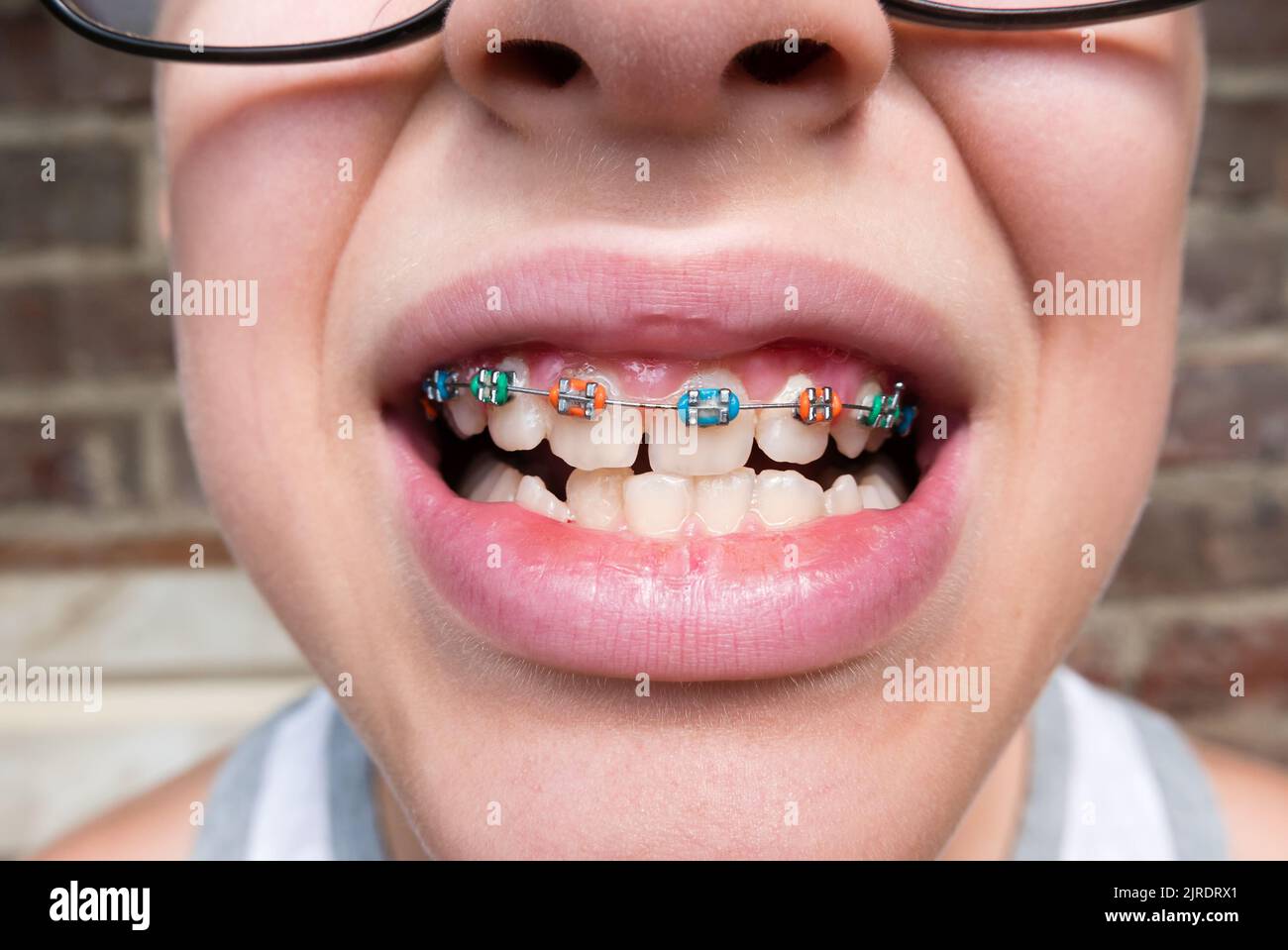 Young boy with abnormal teeth position and correction with orthodontic