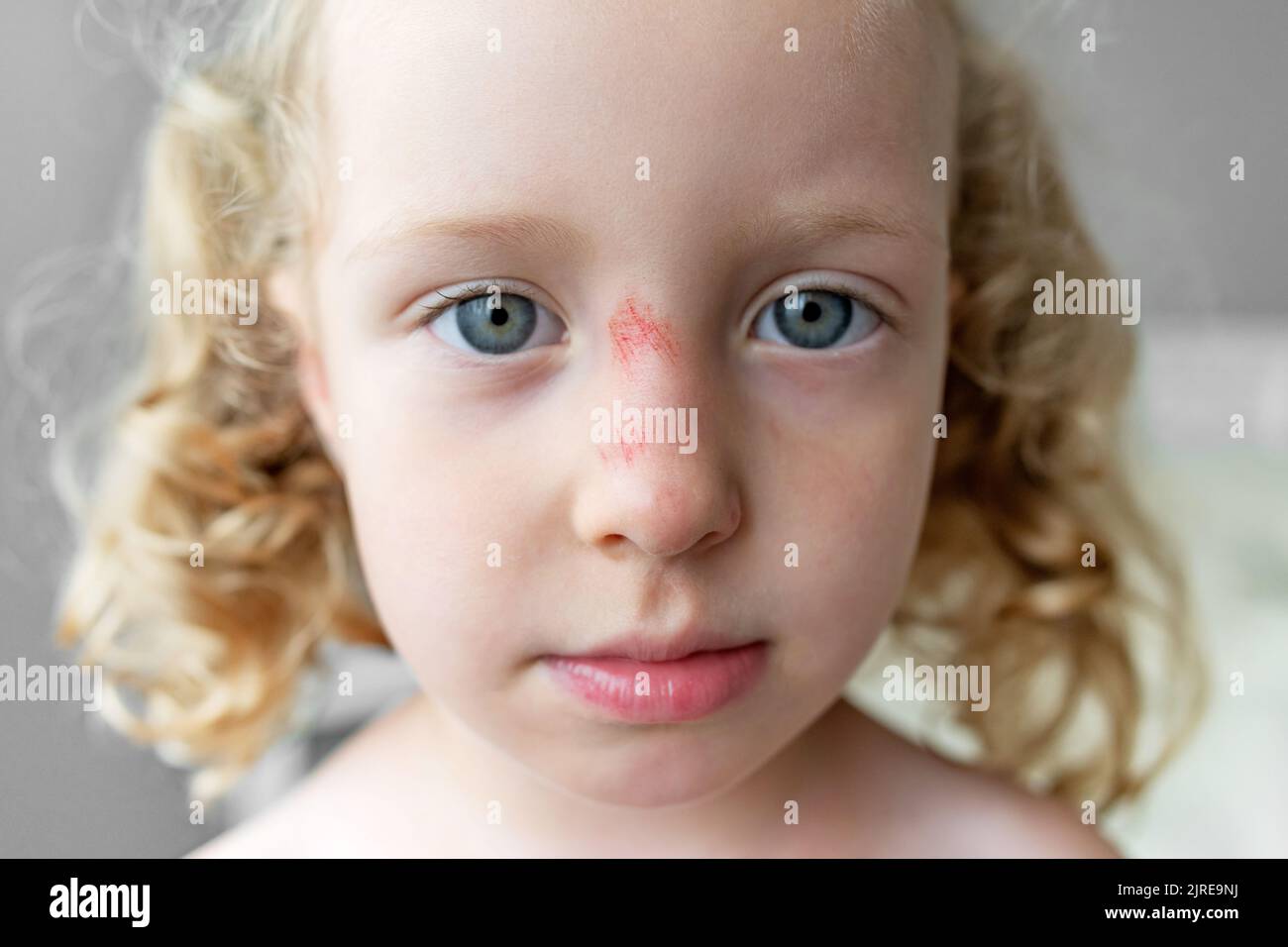 Closeup of the face of a sad child with a scratch on his nose Stock