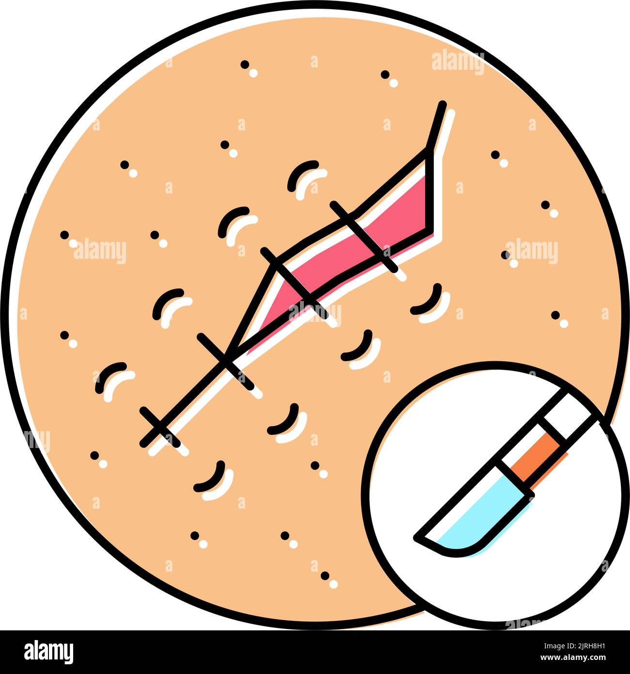 Cryosurgery cancer hi-res stock photography and images - Alamy