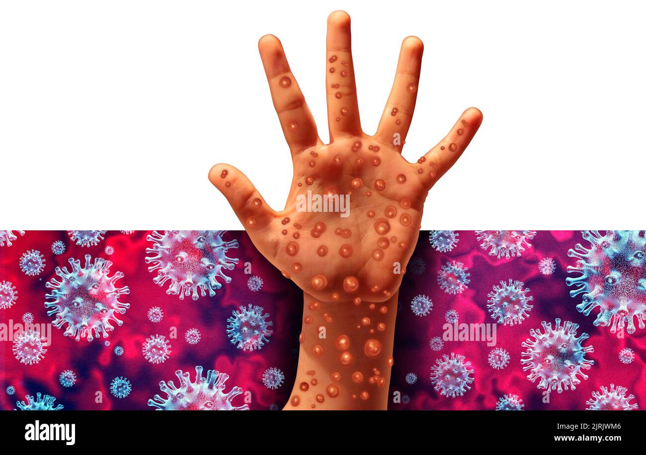 Monkeypox Virus Outbreak as a contagious infection as blisters and leisons on the skin representing the transmission of an infected person. Stock Photo