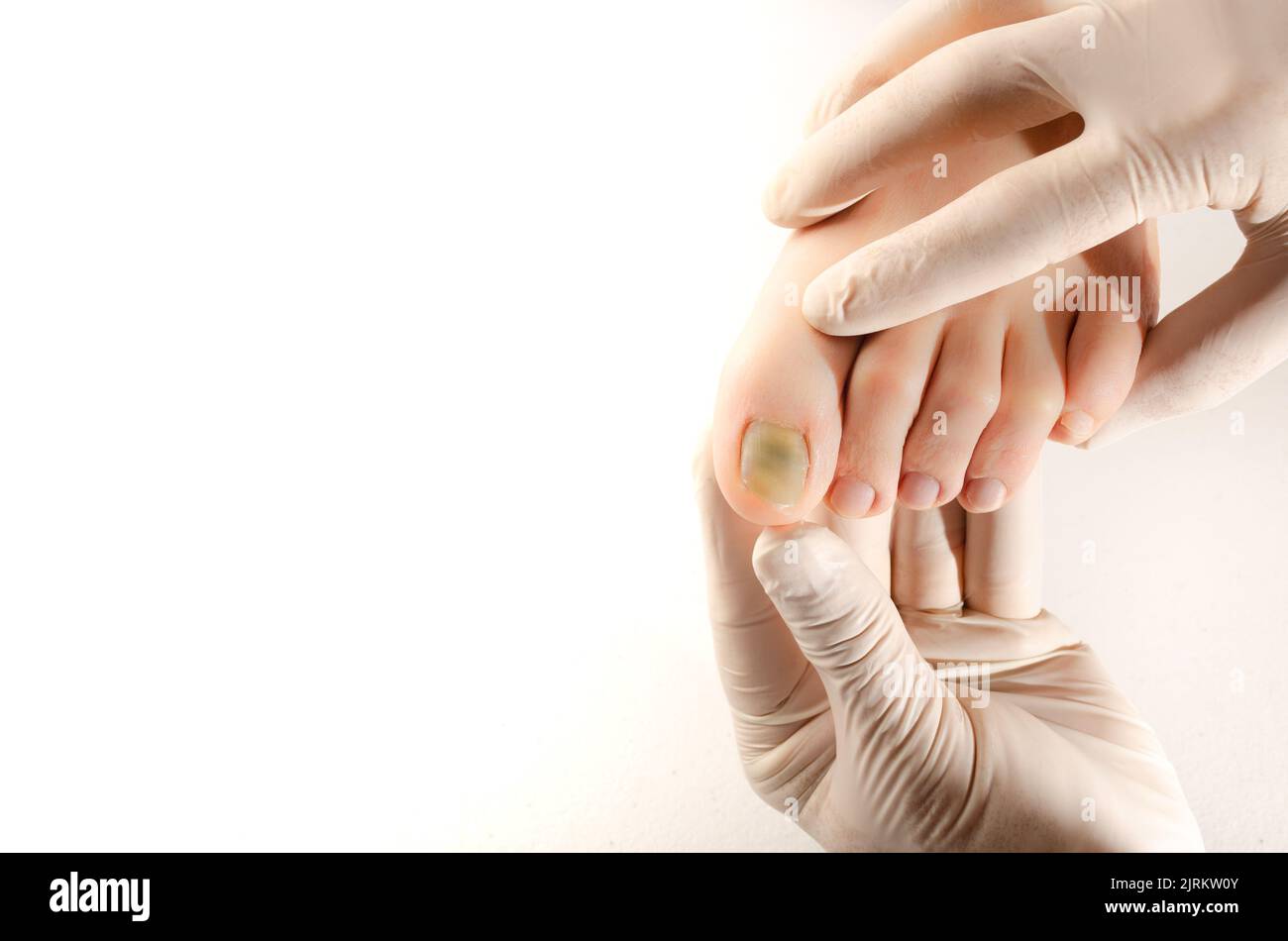 Doctor with white gloves, takes in his hands subungual hematoma in the