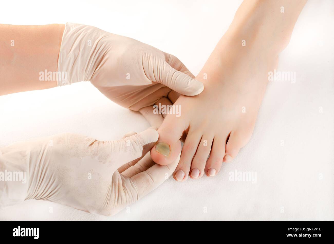 Doctor with white gloves, takes in his hands subungual hematoma in the