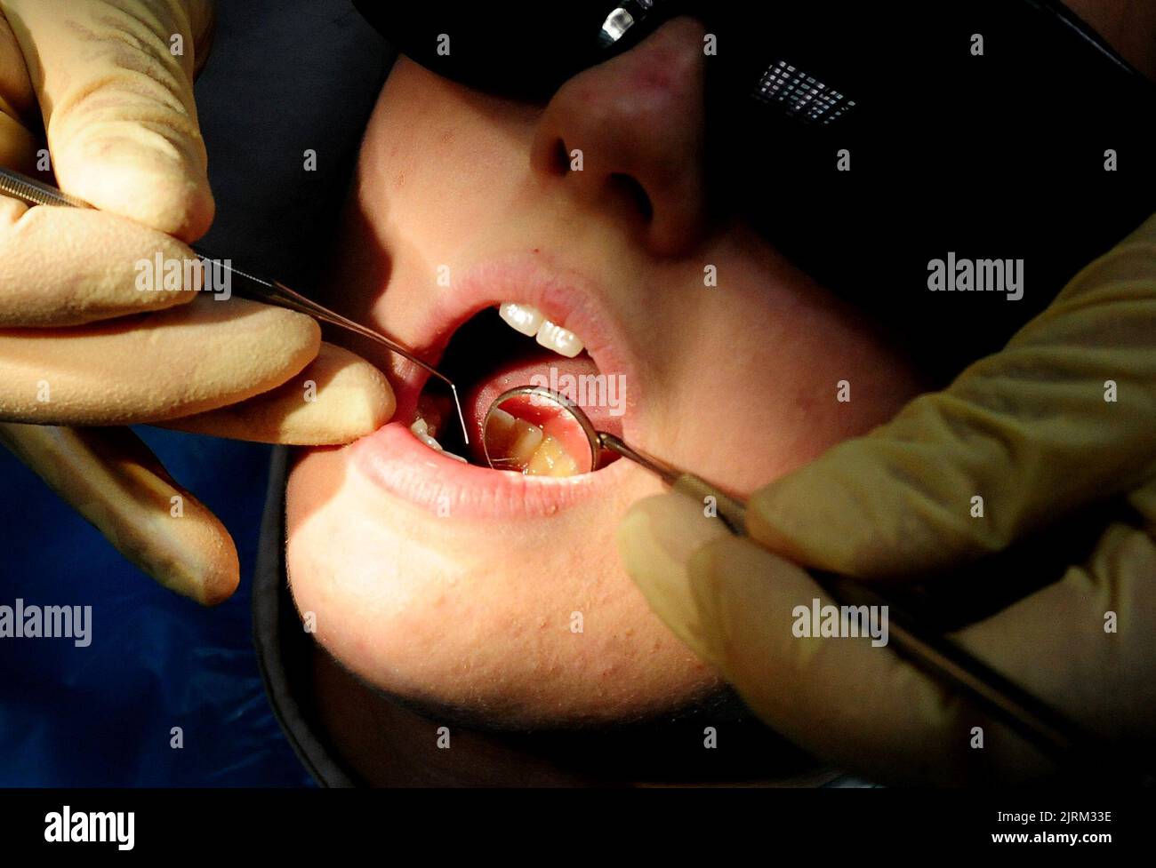 File photo dated 19/05/11 of a dentist at work. Despite a surge in the number of dental treatments carried out across England, sector leaders have warned that NHS dentistry is on its 'last legs'. Issue date: Thursday August 25, 2022. Stock Photo
