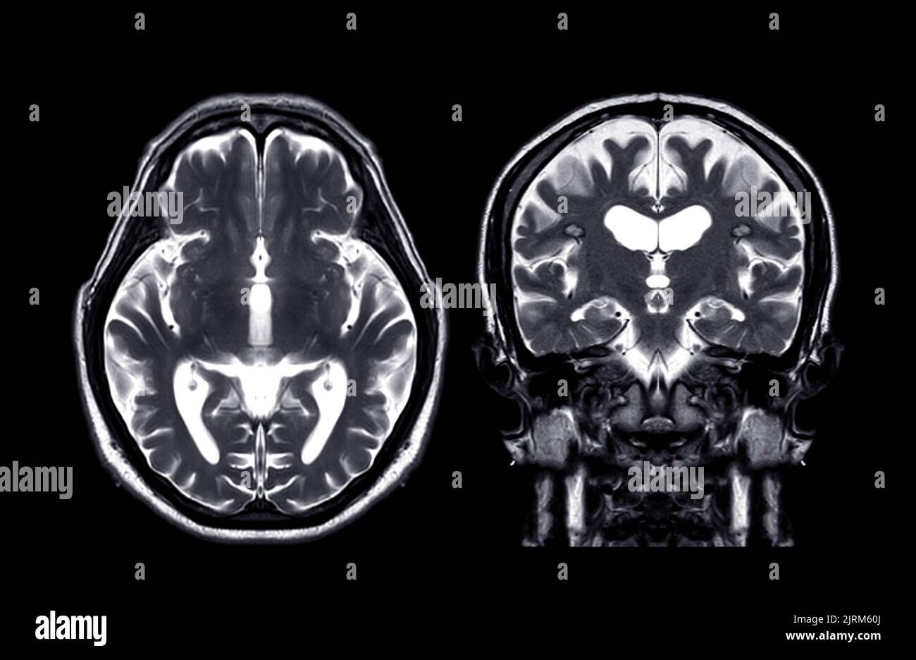 MRI brain Axial T2 and coronal t2 f technique for detect a variety of ...