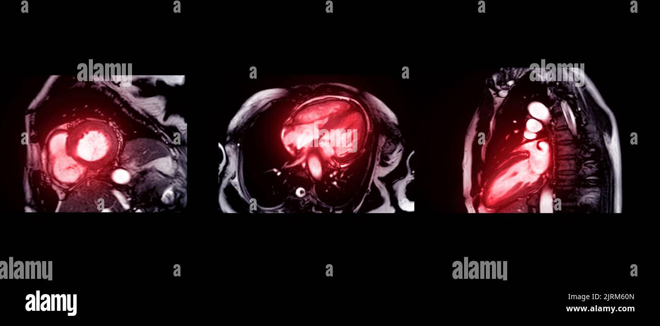 Collection of MRI heart or Cardiac MRI ( resonance imaging
