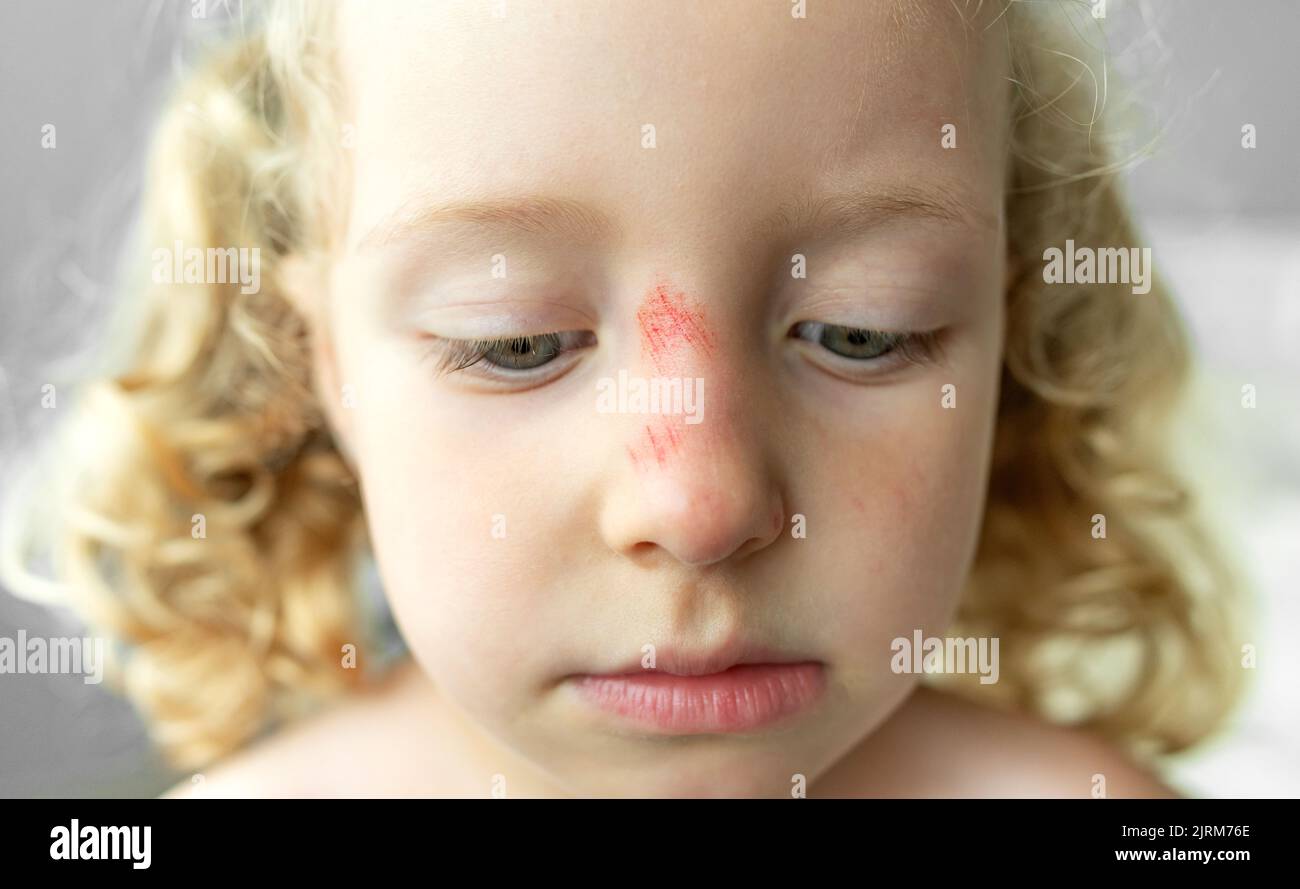 Close-up of the face of a sad child with a scratch on his nose. Stock Photo