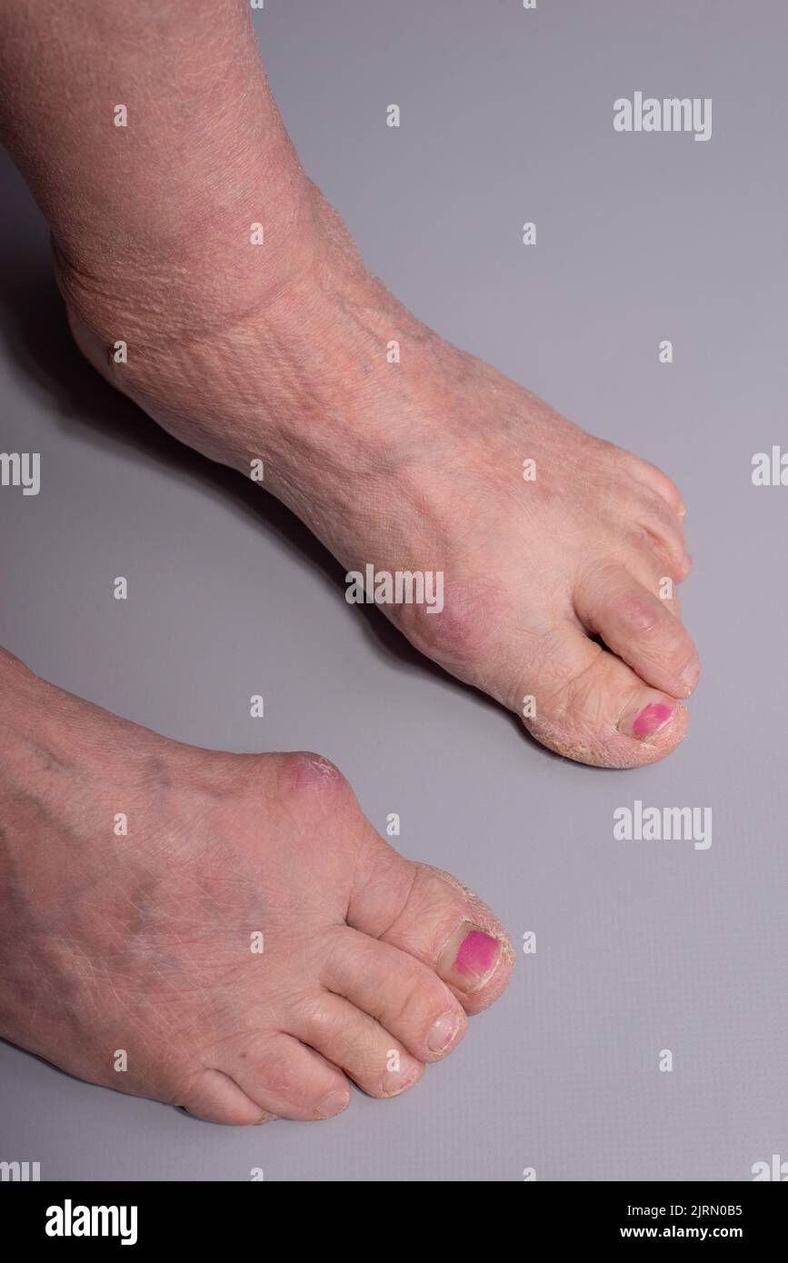 closeup of big toe disease curvature in elderly woman on gray
