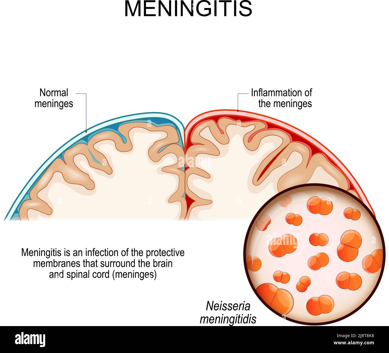 Meningitis is an infection of the protective membranes that surround the brain and spinal cord. Human's brain with meninges Stock Vector