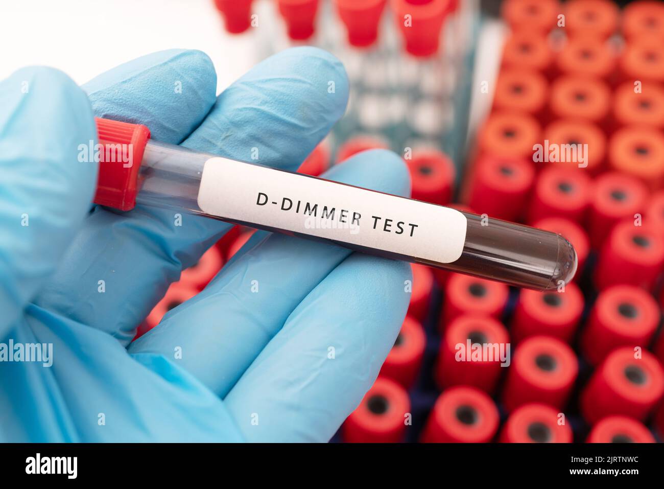 Hand holding a glass of test tube with patient's blood for testing D ...