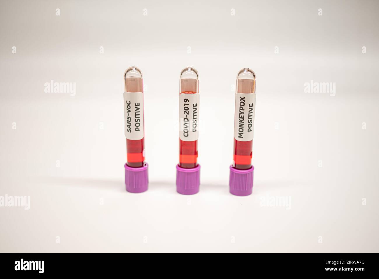 COVID-19,SARS,MONKEYPOX positive,Blood test Stock Photo