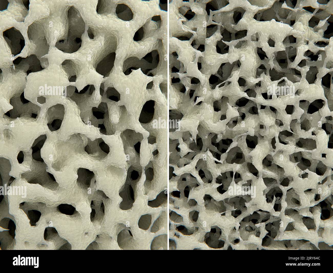 Healthy and osteoporotic bone tissue, illustration Stock Photo