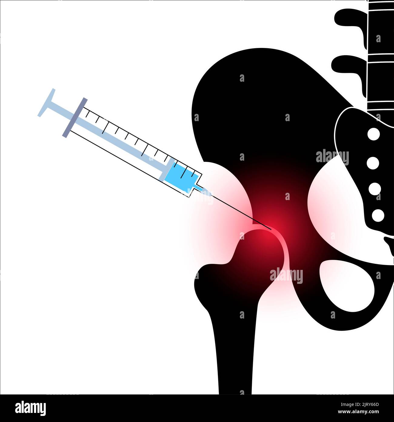 Hip joint injection, illustration Stock Photo Alamy