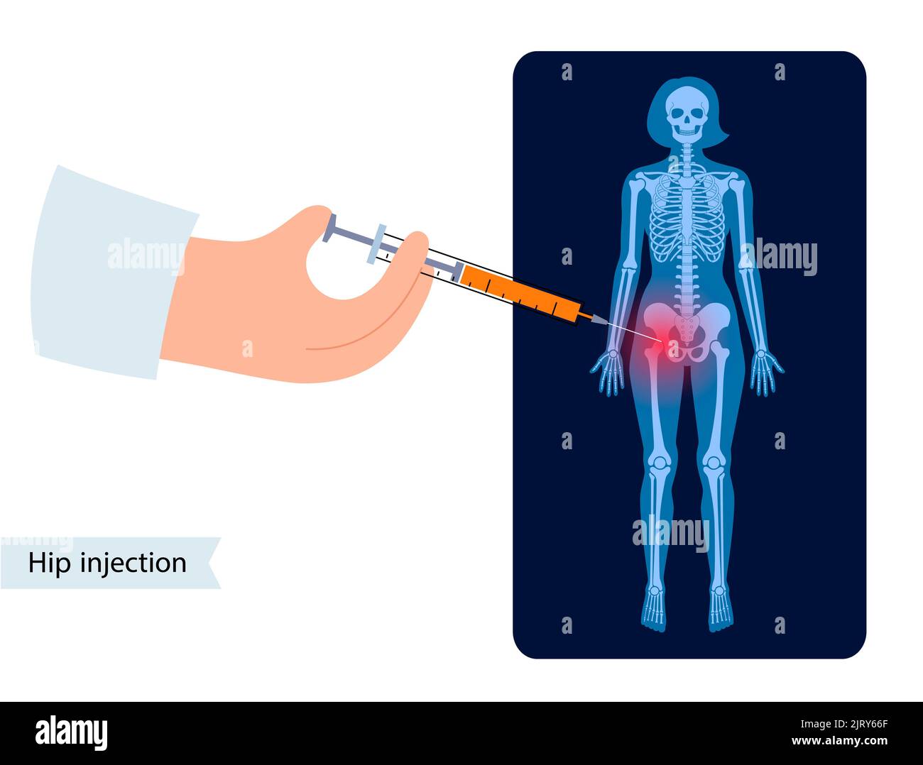 Hip joint injection, illustration Stock Photo Alamy