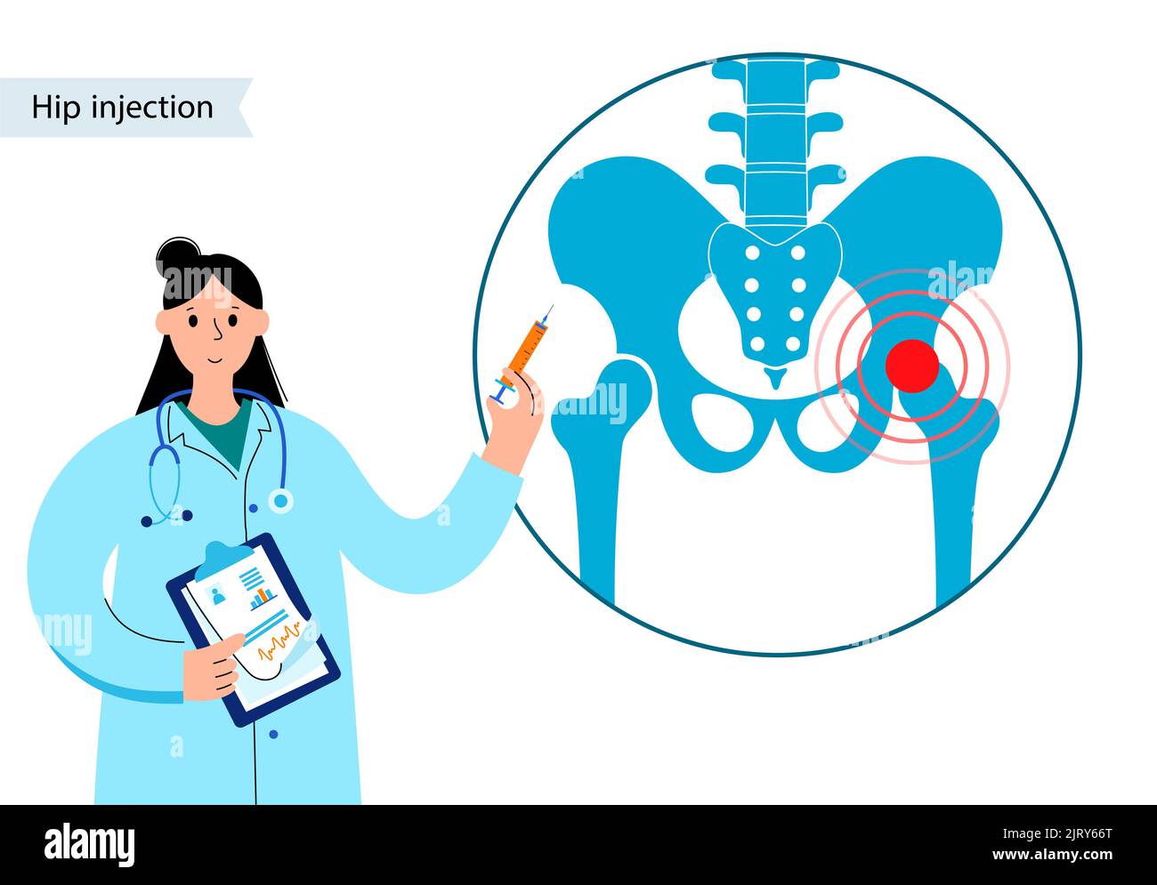 Hip joint injection, illustration Stock Photo Alamy