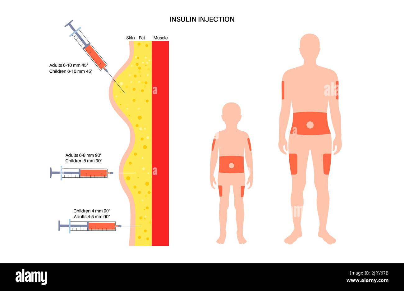 Insulin injection sites, illustration Stock Photo Alamy
