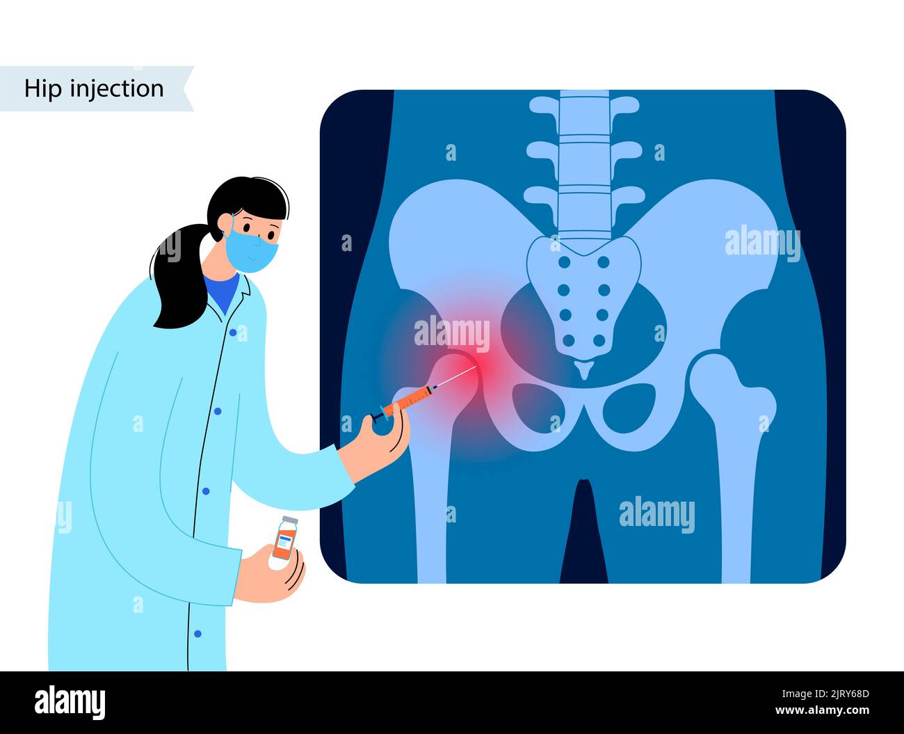 Hip joint injection, illustration Stock Photo Alamy