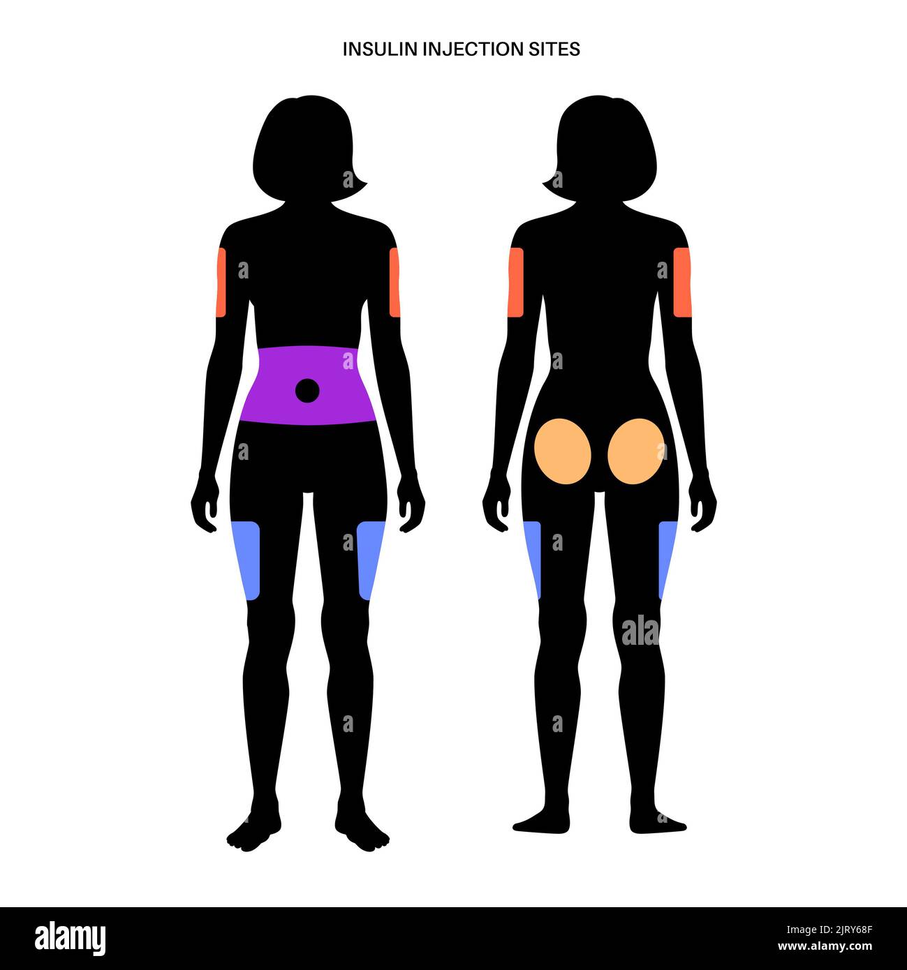 Insulin injection sites, illustration Stock Photo Alamy