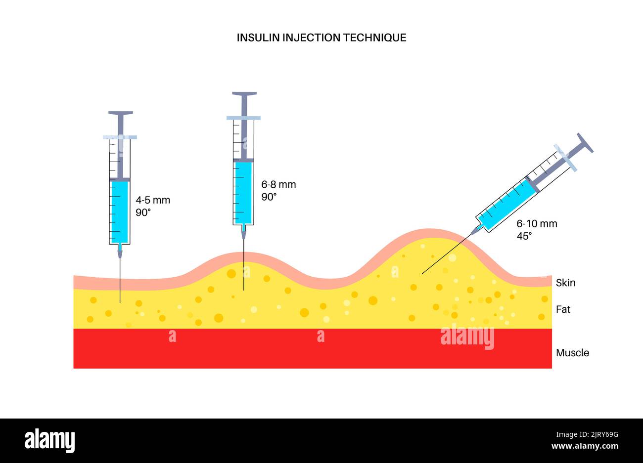 Insulin injection sites, illustration Stock Photo