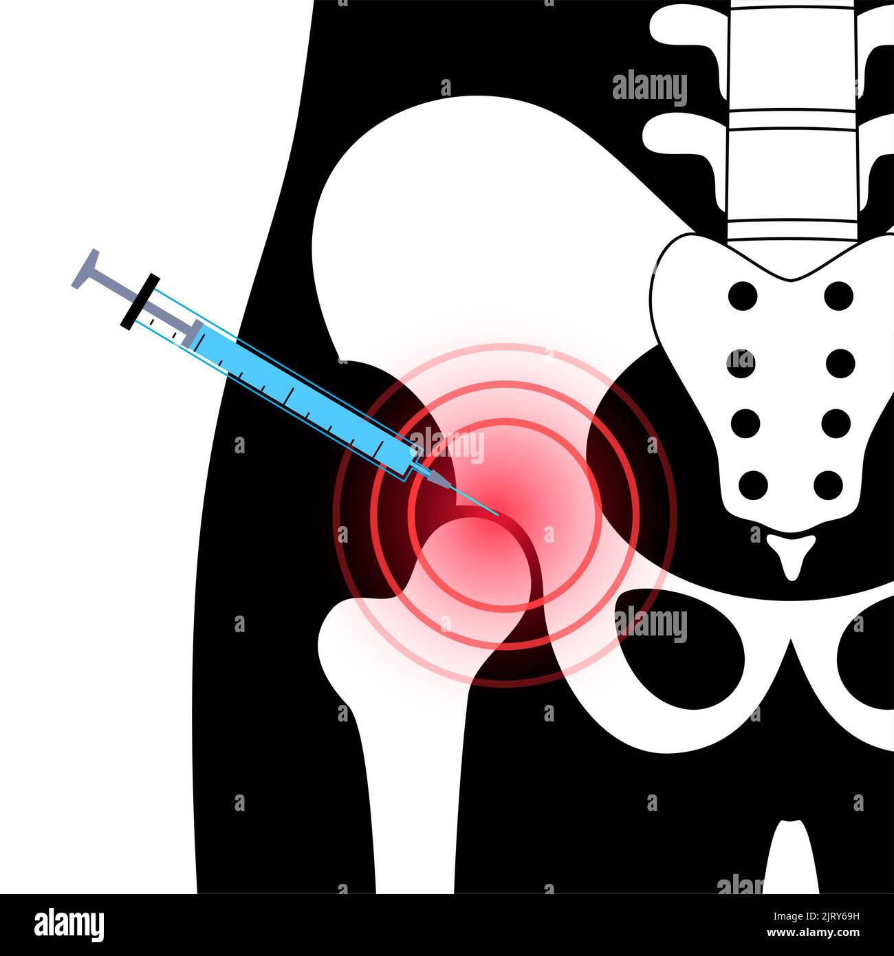 Hip joint injection, illustration Stock Photo - Alamy
