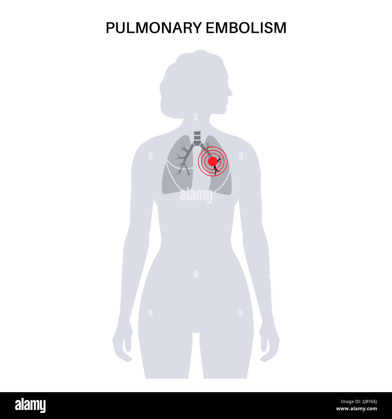 Pulmonary embolism, illustration Stock Photo Alamy