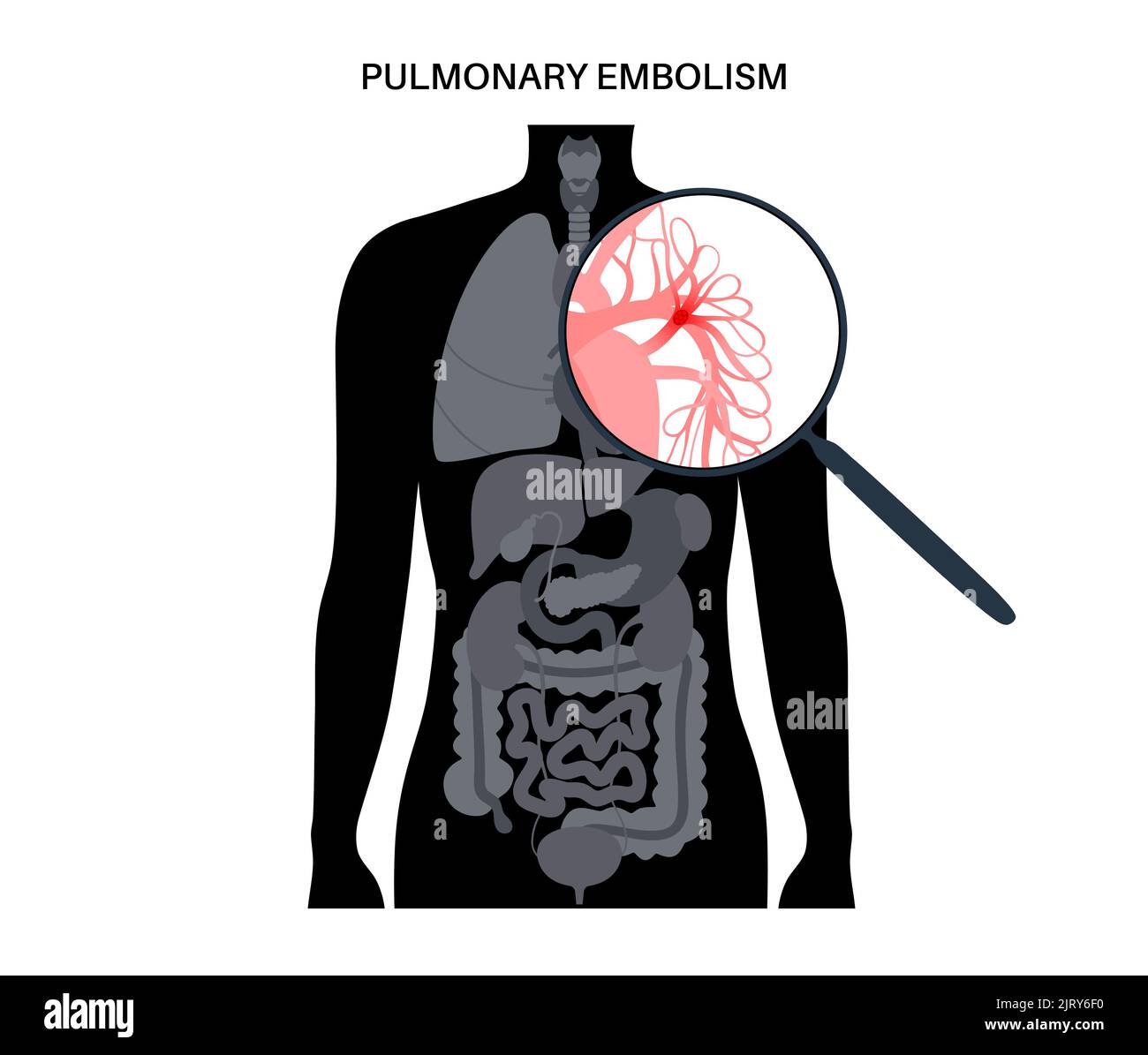 pulmonary-embolism-illustration-stock-photo-alamy