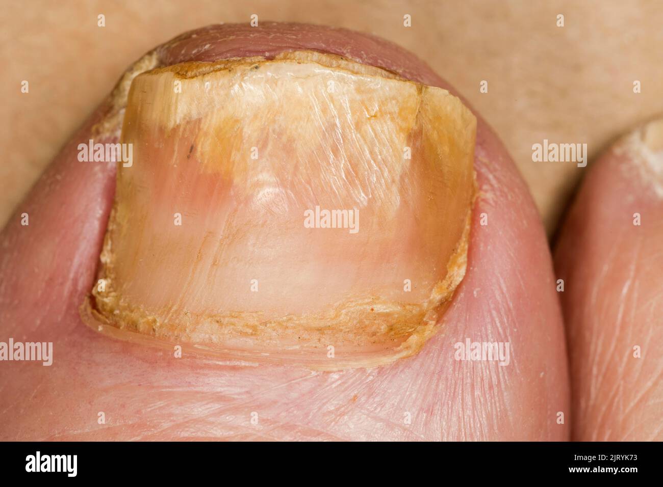 Nail fungus (onychomycosis) on the big right toe Stock Photo