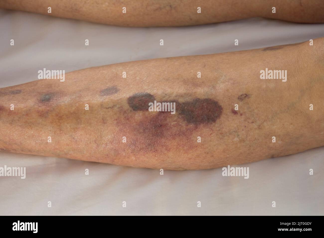 Severe bruising to woman's leg UK Stock Photo Alamy