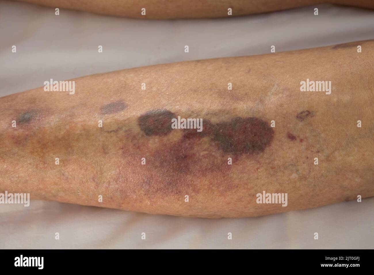 Bruising hematomas hi-res stock photography and images - Alamy