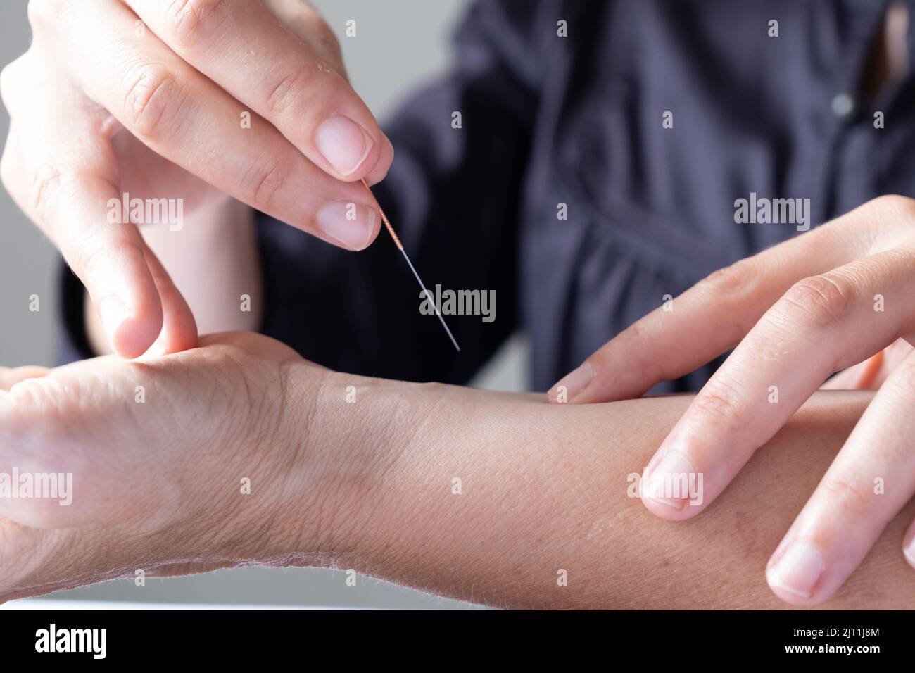 Profesional woman giving acupuncture treatment. High quality photo ...
