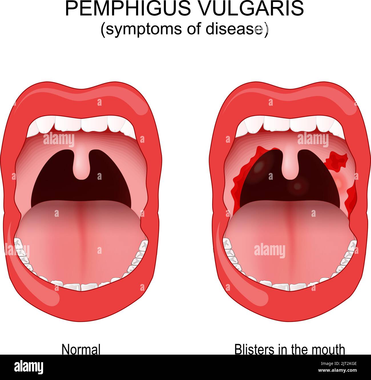 Pemphigus vulgaris. problem with the immune system. person wit affected area inside the mouth and throat blisters. Early symptoms of disease. vector i Stock Vector