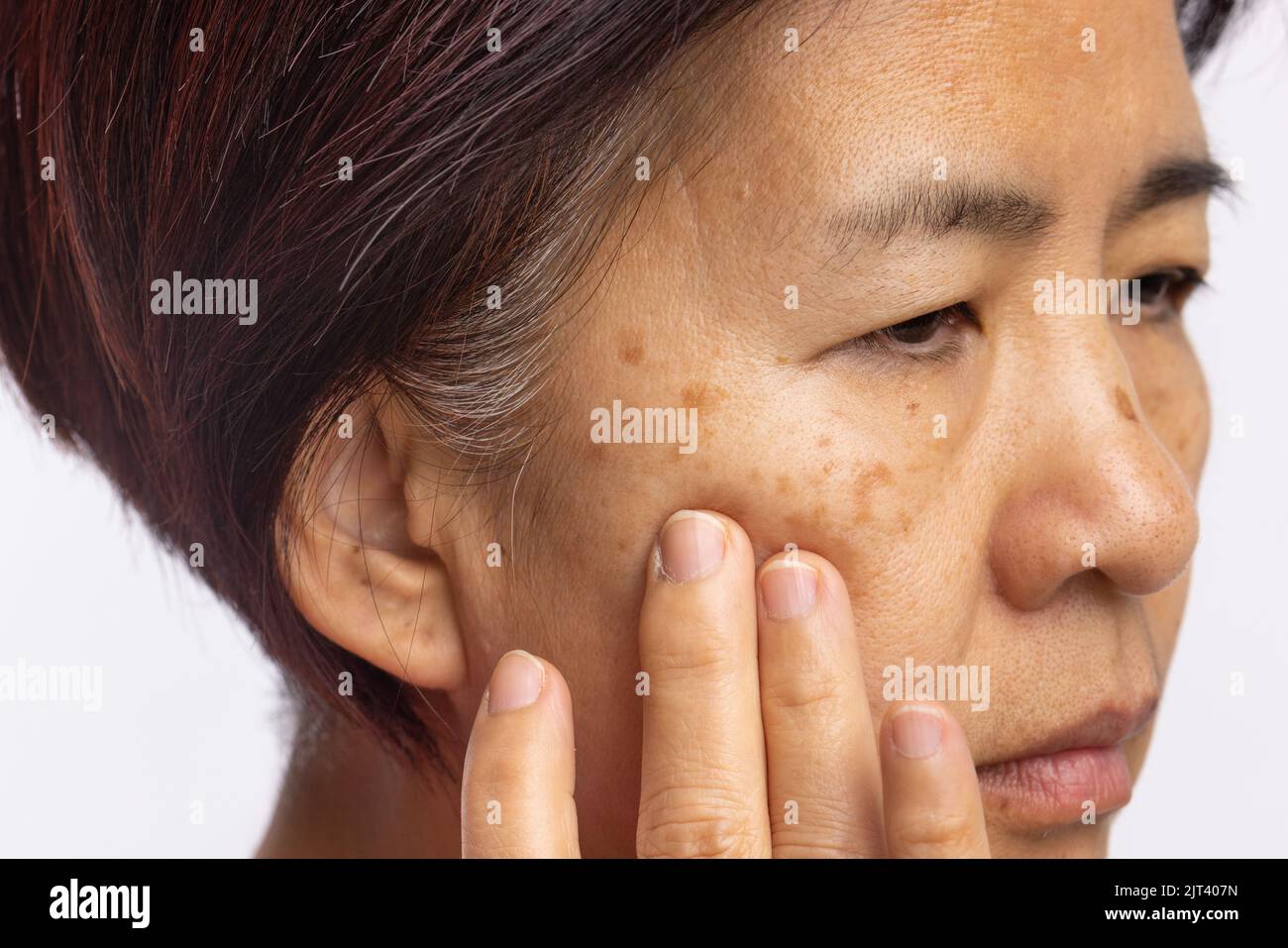 Menopausal women worry about melasma on face Stock Photo Alamy