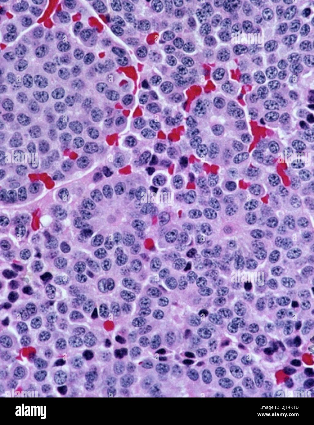 Typical carcinoid tumor of the lung, prominent rosettes. Stock Photo