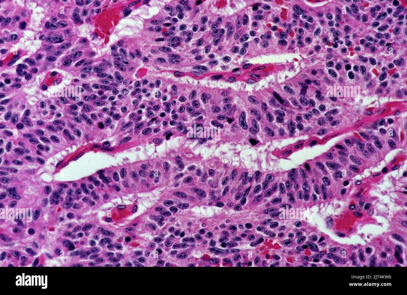 Typical carcinoid tumor of the lung, trabecular pattern. Stock Photo