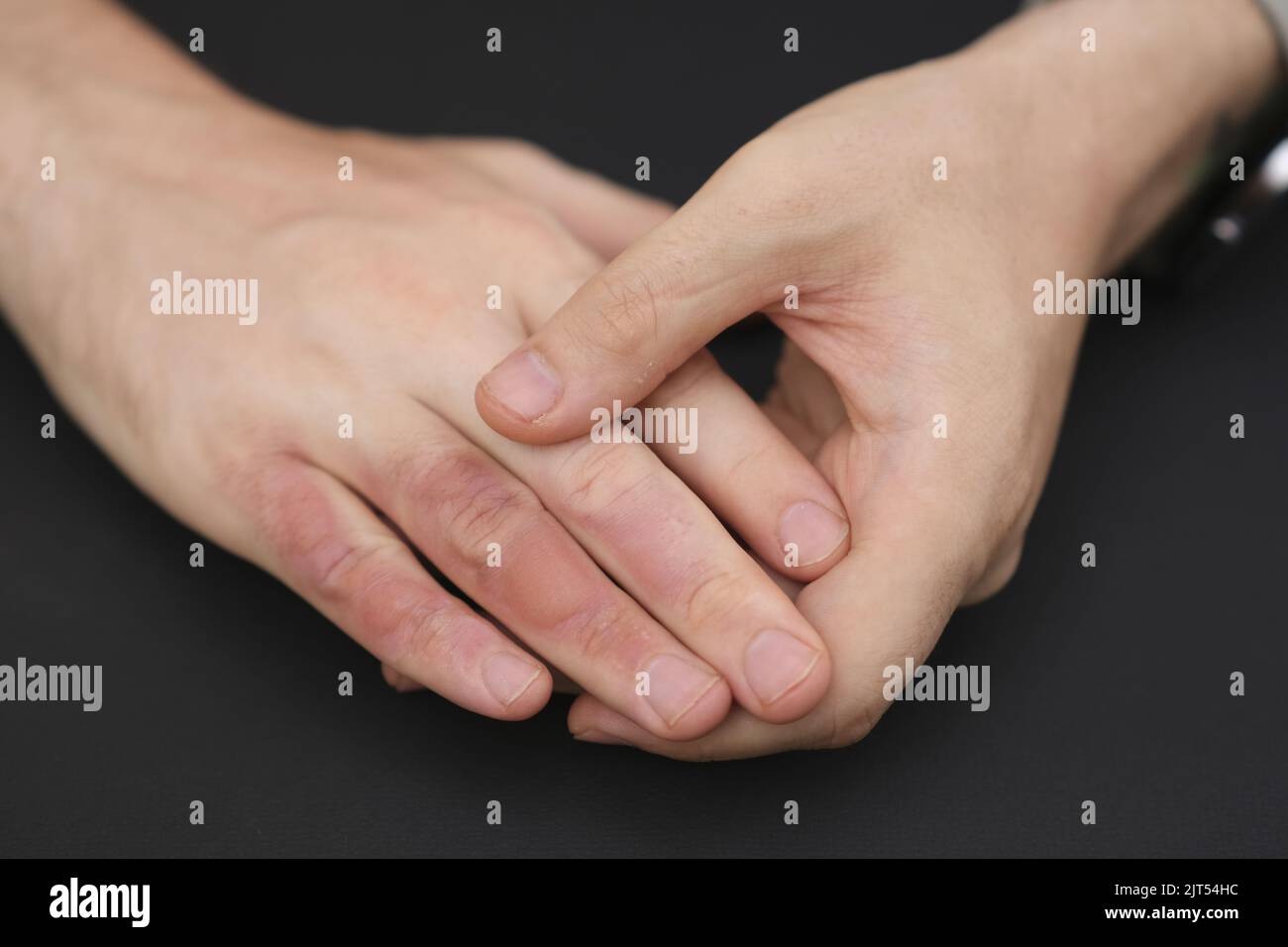Man with burn on her hand, closeup. Burn blister on the hand. Hand male