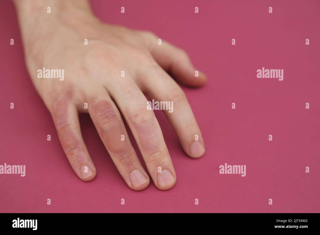 Man with burn on her hand, closeup. Burn blister on the hand. Hand male with blisters due to