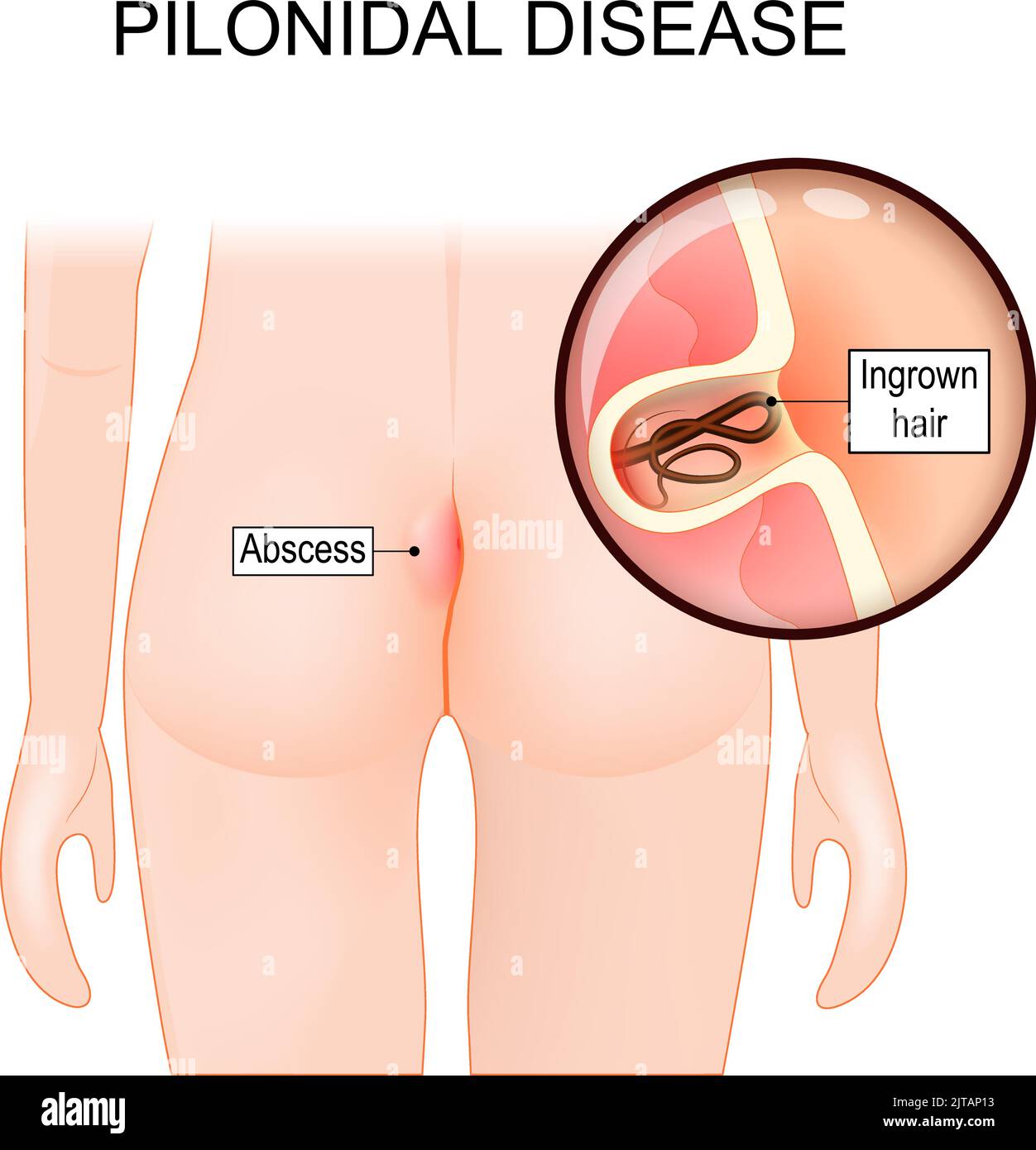 Sinus surgery hi-res stock photography and images - Alamy Sinus surgery hi-res stock photography and images - Alamy