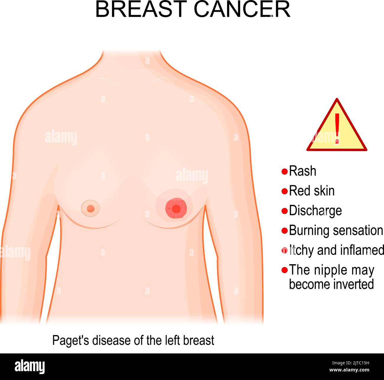 breast cancer symptoms. Paget's disease of the male and female breast. Vector poster for Self Examination. Part of female torso with Paget's disease Stock Vector