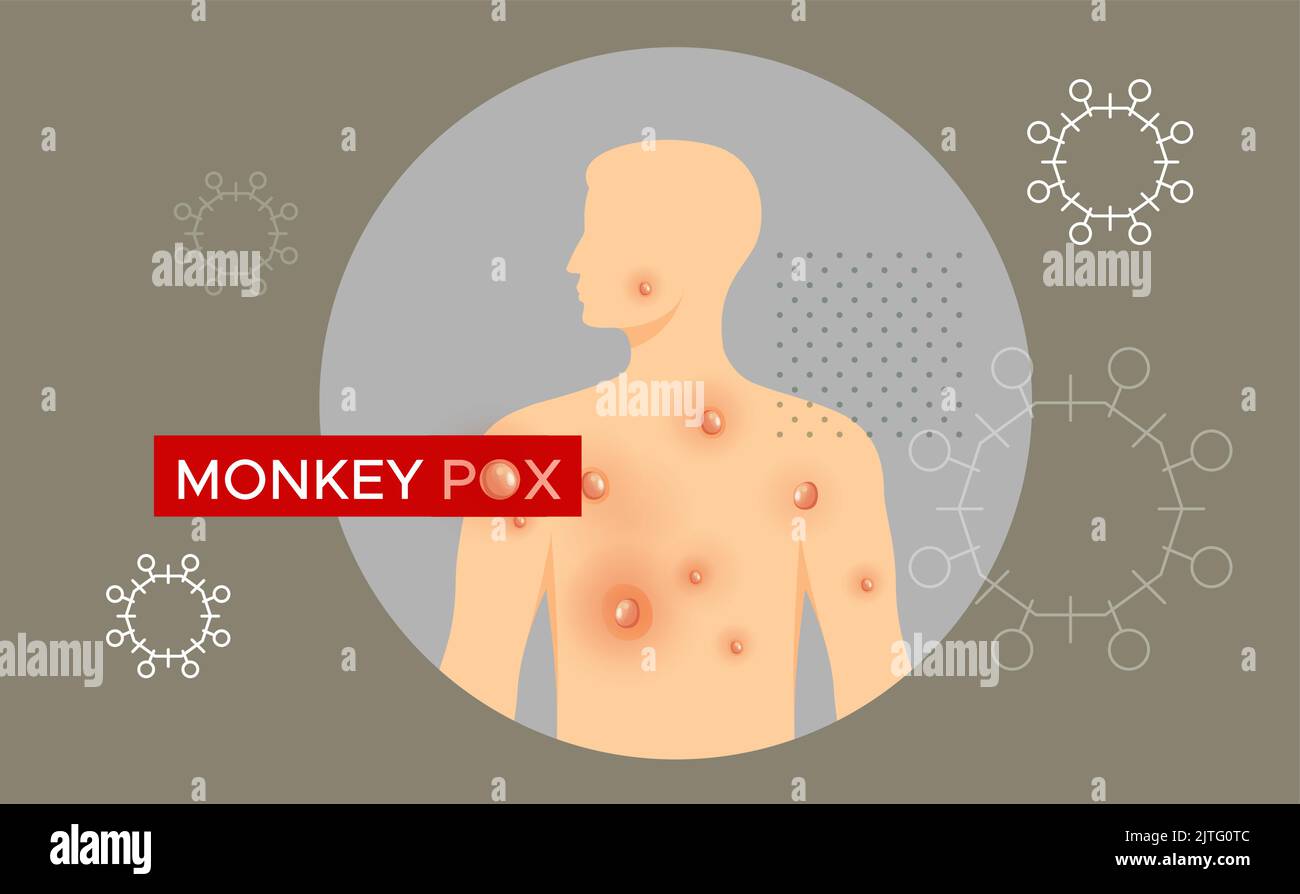 Monkeypox - Skin Rashes and Spots as Symptoms - Icon as EPS 10 File ...