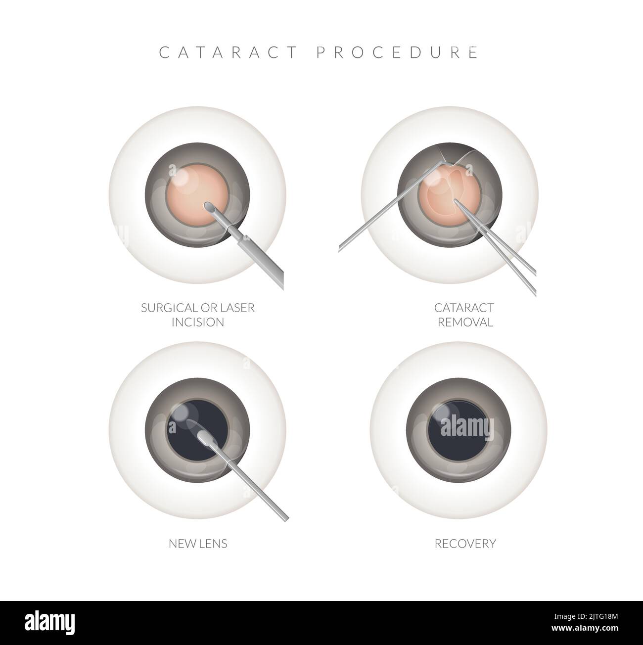 Human Eye - Cataract Procedure - Illustration as EPS 10 File Stock ...
