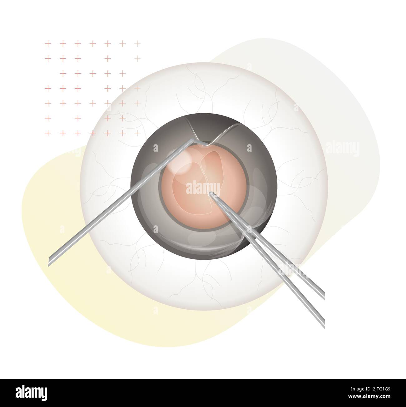 Human Eye - Cataract Procedure - Illustration as EPS 10 File Stock ...
