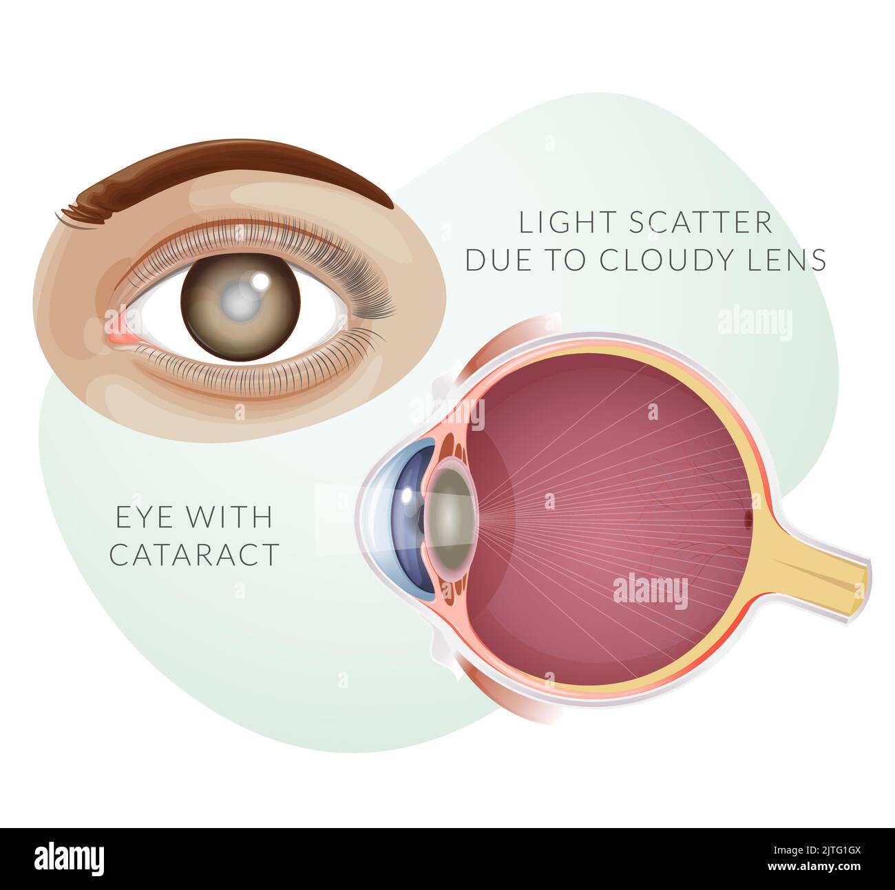 Human Eye with Cataract - Cloudy Lens - Illustration as EPS 10 File Stock Vector